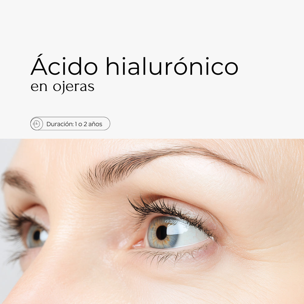 El tratamiento de ácido hialurónico en ojeras es una técnica no quirúrgica que se utiliza para rellenar y rejuvenecer el área de las ojeras. Este tratamiento emplea ácido hialurónico para hidratar y restaurar volumen en la zona, reduciendo la apariencia de las sombras y las bolsas, logrando un aspecto más descansado y juvenil.