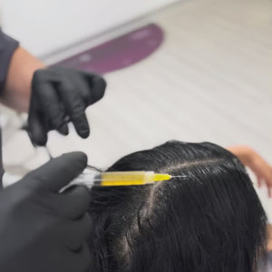 El tratamiento plasma capilar, también conocido como PRP (Plasma Rico en Plaquetas), es una técnica innovadora que utiliza la sangre del propio paciente para estimular el crecimiento capilar. A través de la extracción de una pequeña cantidad de sangre, se obtiene el plasma rico en plaquetas, que luego se inyecta en el cuero cabelludo para regenerar los folículos pilosos y promover el crecimiento de nuevos cabellos.